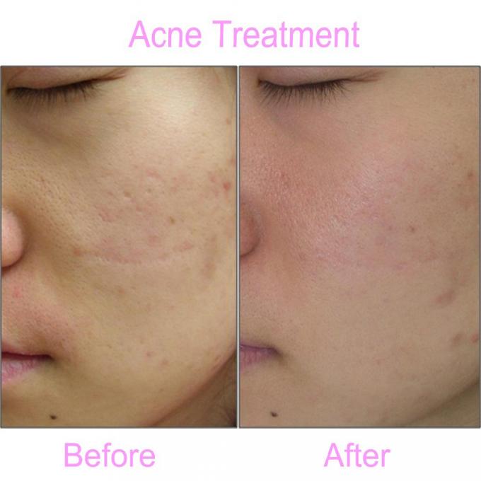 Acné Treatment.jpg